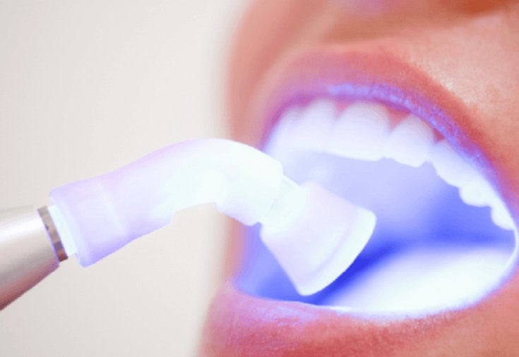 лазерное отбеливание зубов